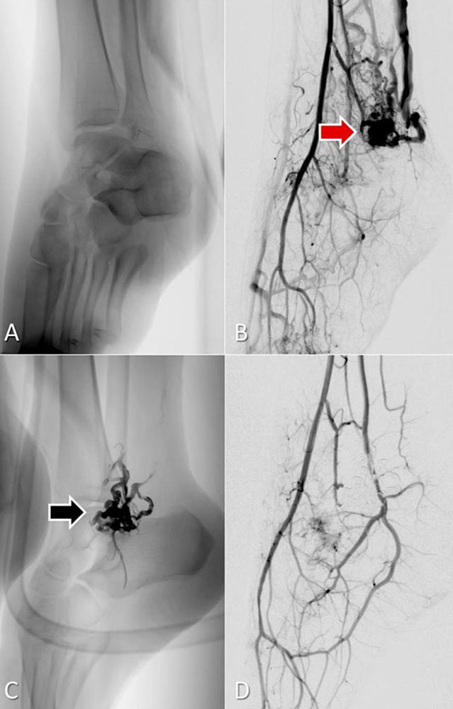 Embolization with liquid embolization agent EVOH