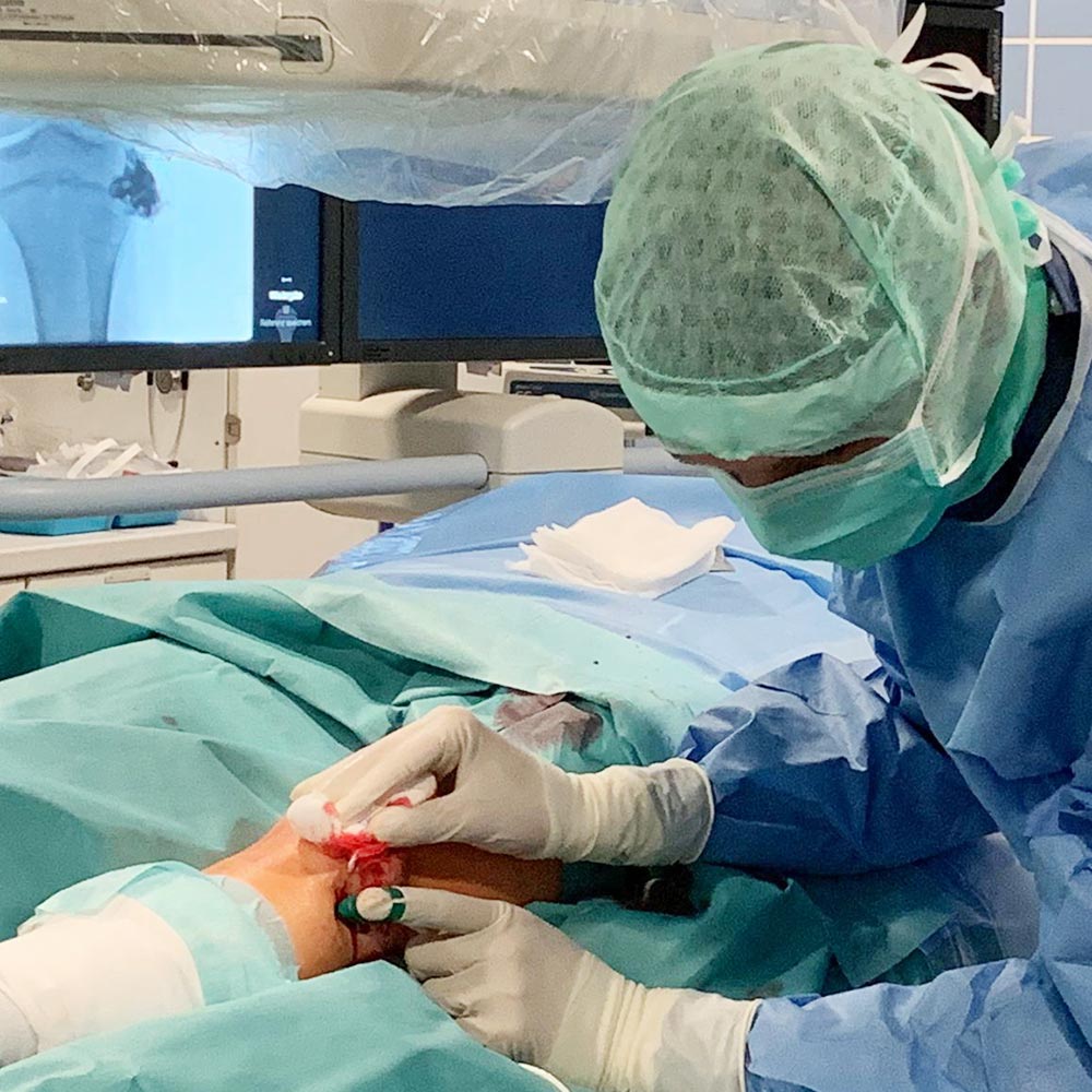 electrosclerotherapy with the finger electrode in a venous malformation