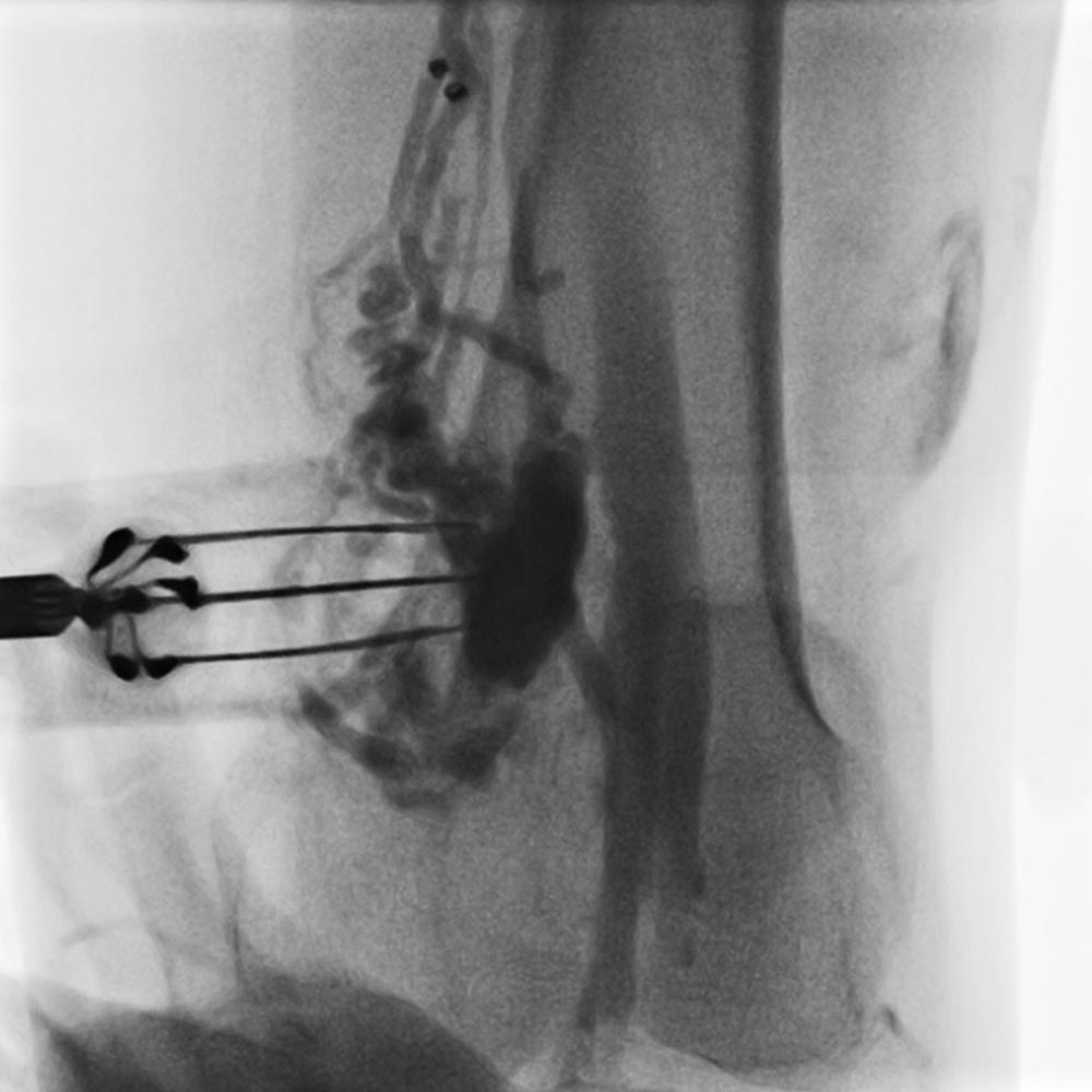 Bleomycin electrosclerotherapy with hexagonal electrode