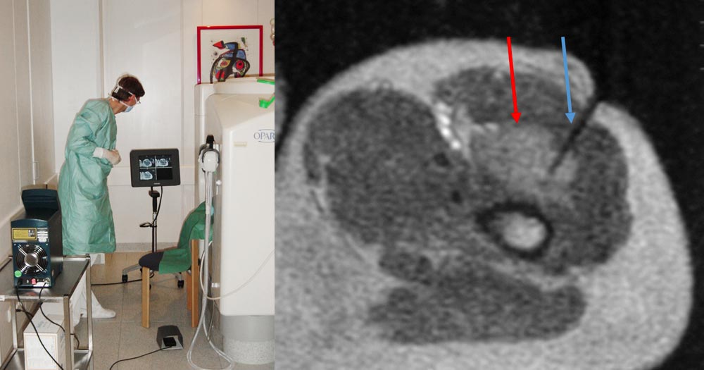 MRI-guided laser-induced interstitial thermotherapy of a venous malformation