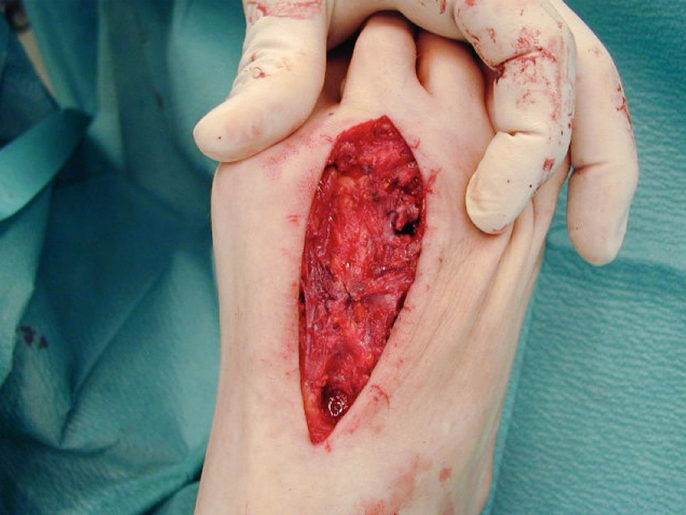 Resection of the venous malformation