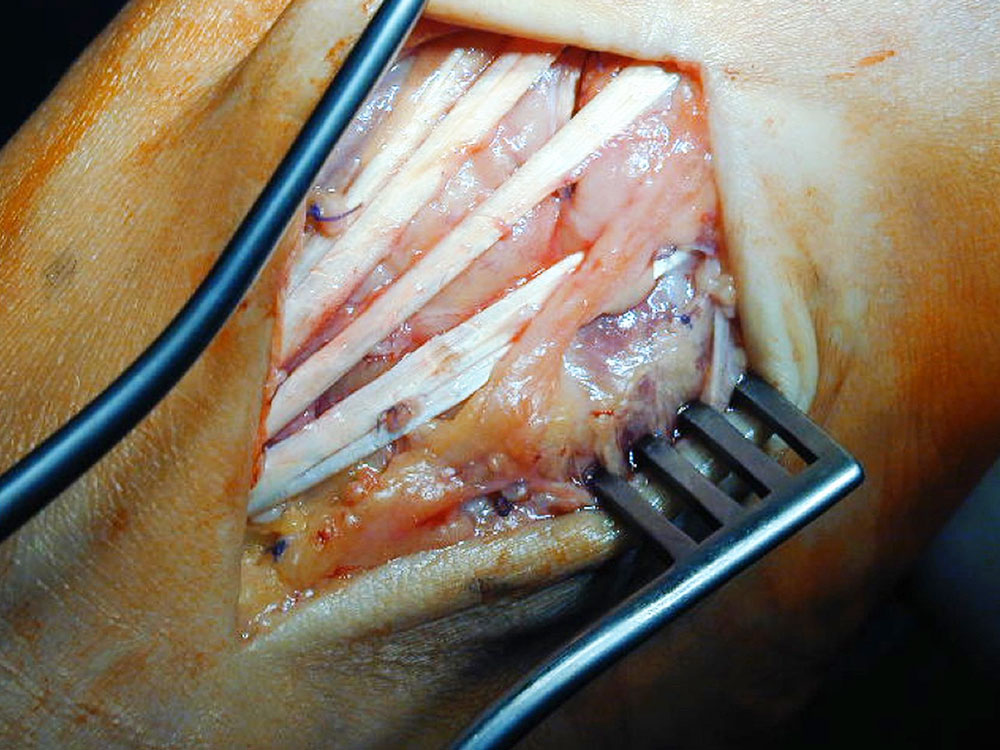 Intraoperative findings after resection of the arteriovenous malformation