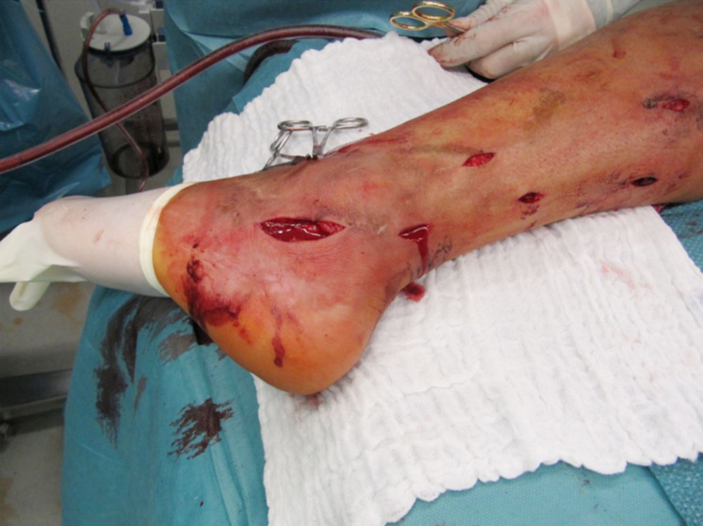 Intraoperative findings in a venous malformationnnn