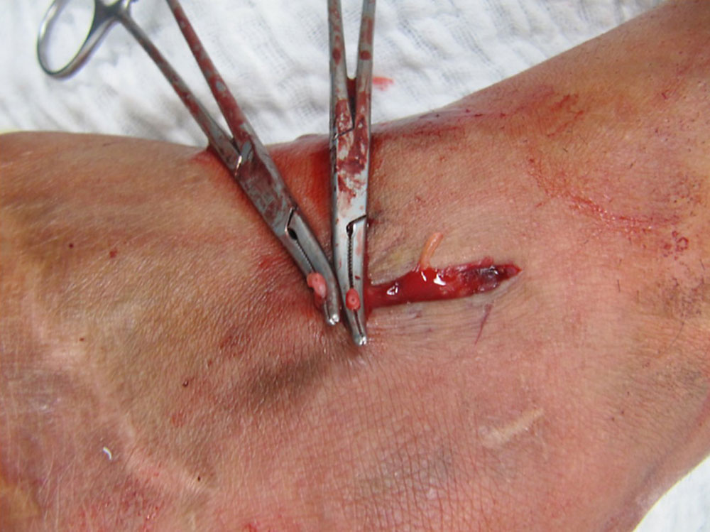 Surgical site on a venous malformation