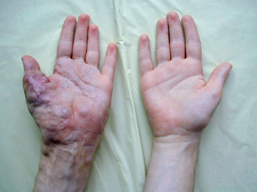 Arteriovenous malformation on the hand