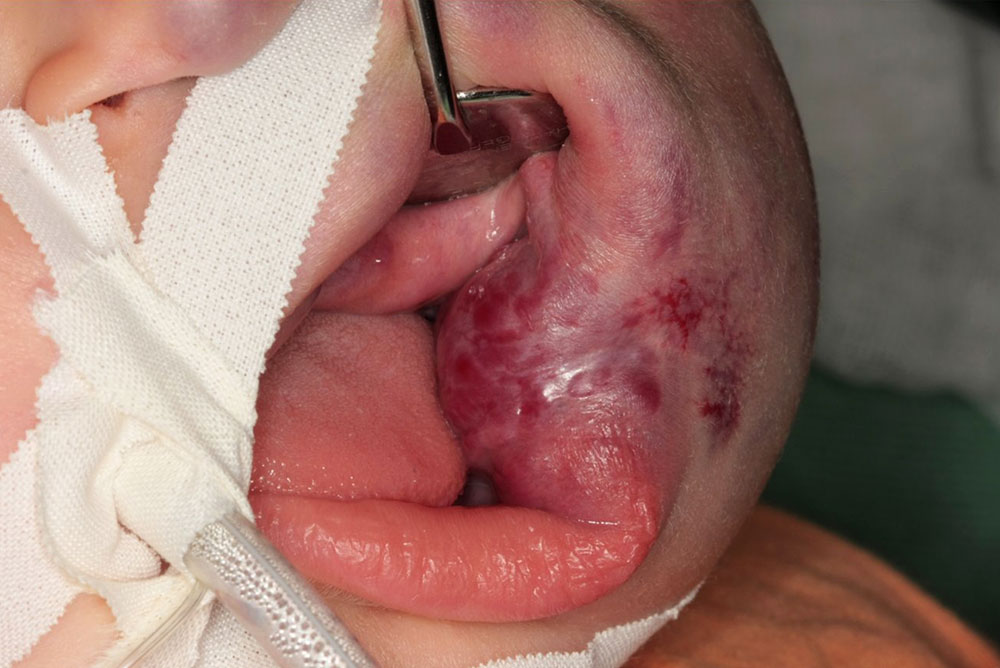 Venous malformation: findings before the first operation.