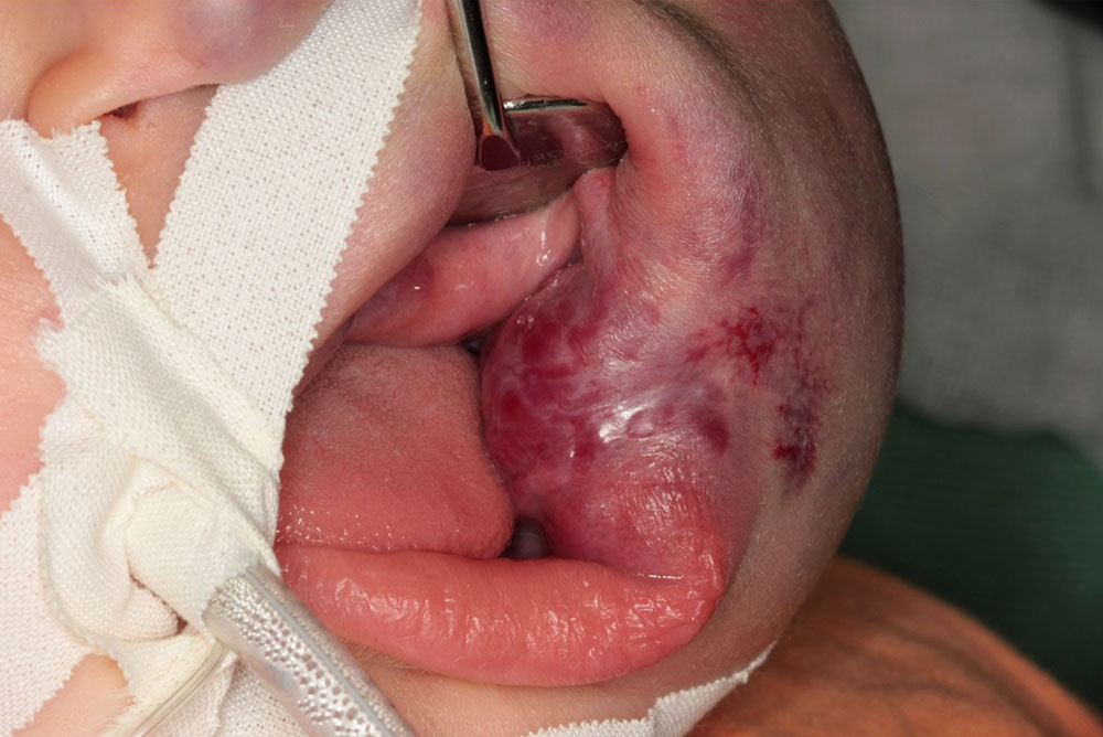 Venous malformation: findings before the first operation.