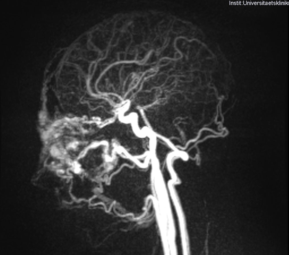 Arteriovenous malformation in the right orbit before surgery 