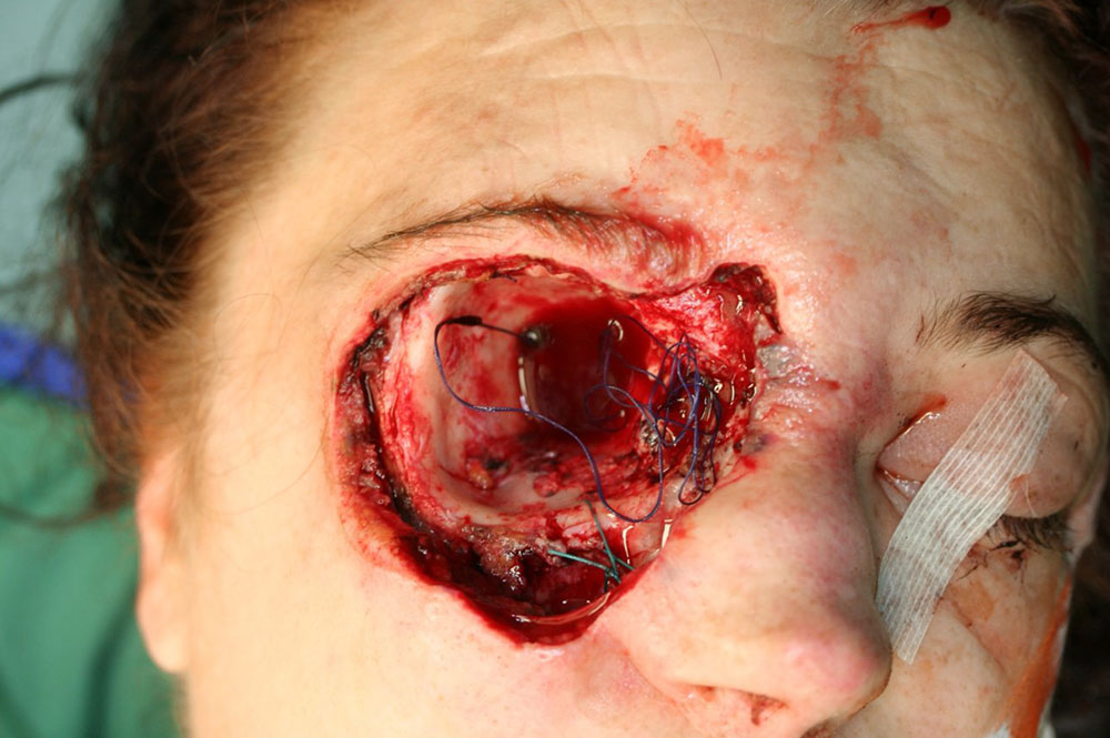 After resection of the malformation