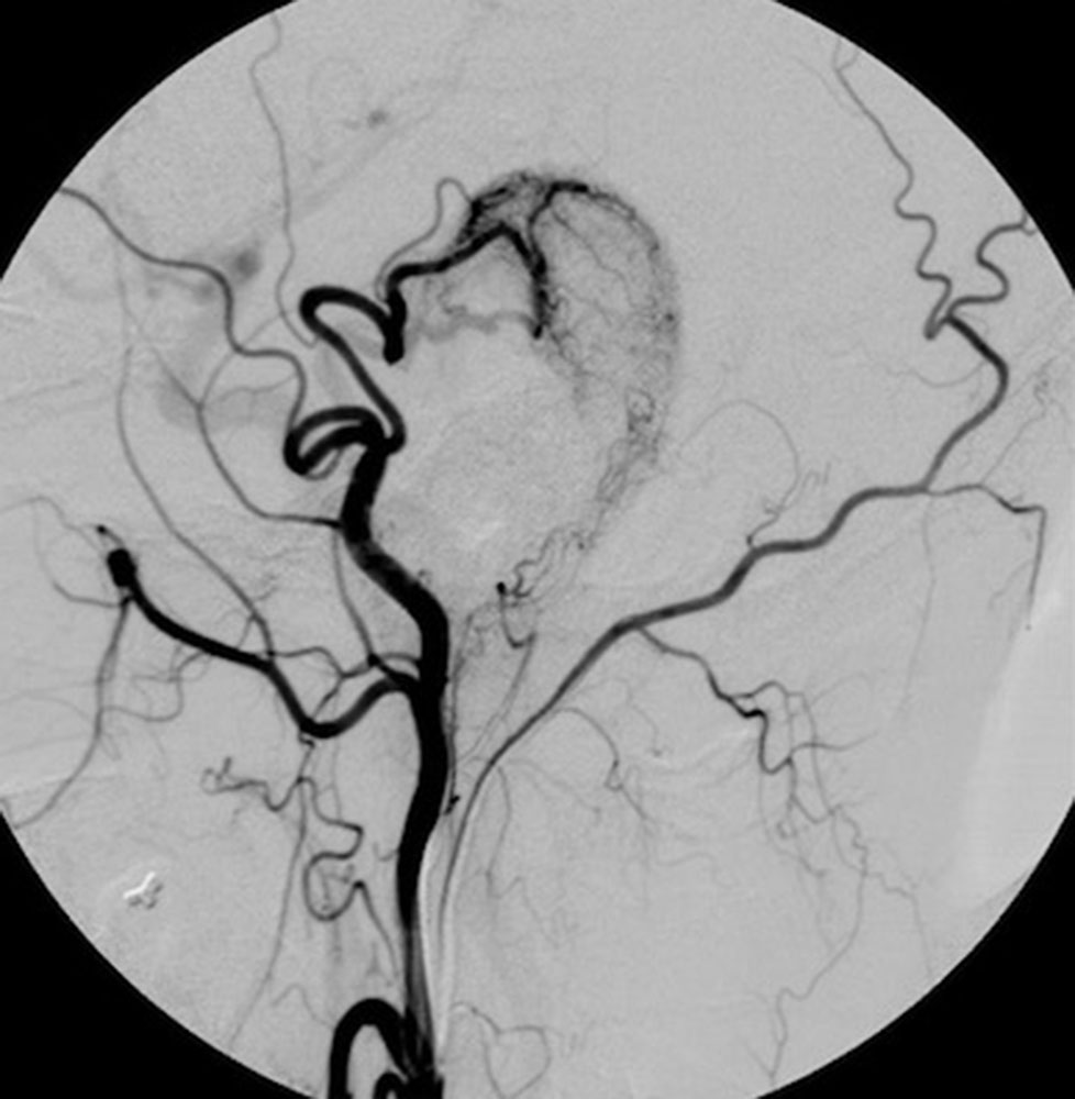 Digital subtraction angiography