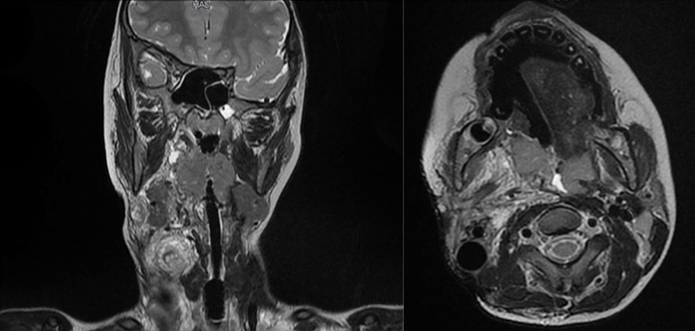 MRI in microcystic lymphatic malformation