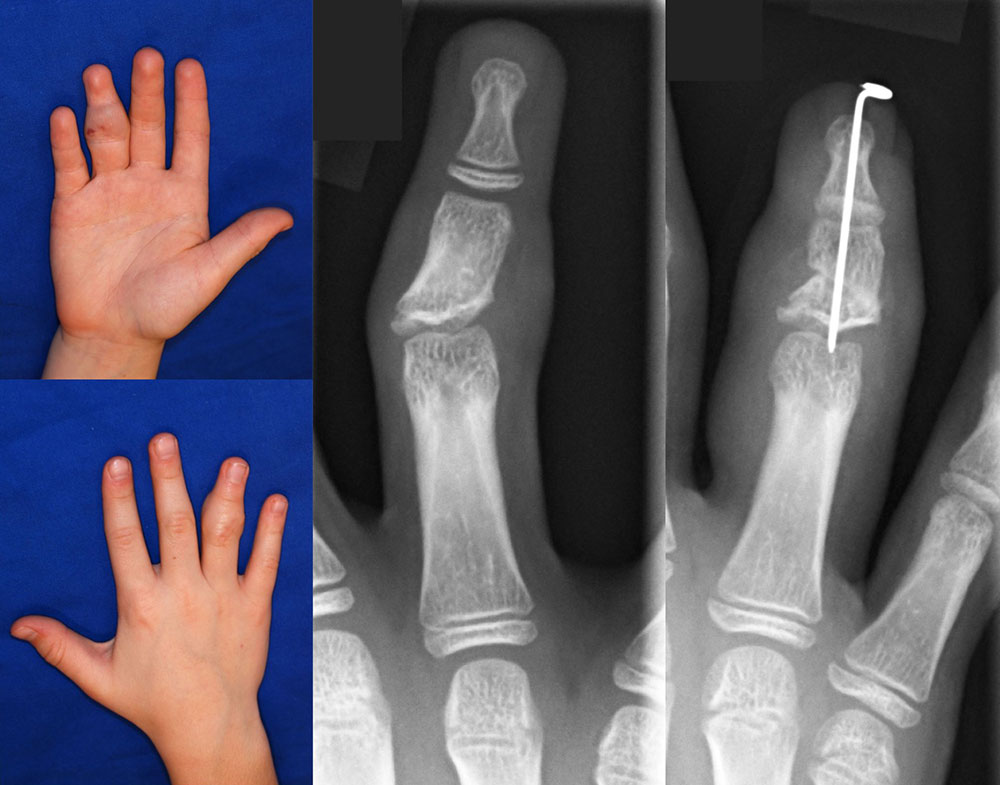 Nd:YAG laser therapy of a venous malformation