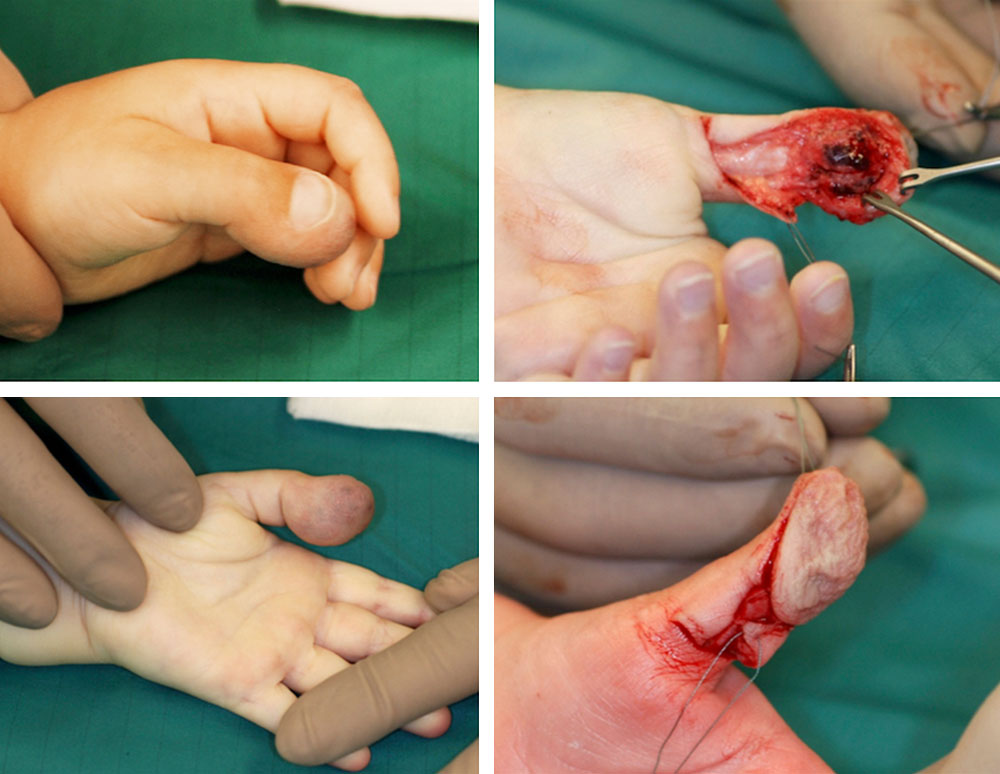 Venous malformation of the entire distal thumb