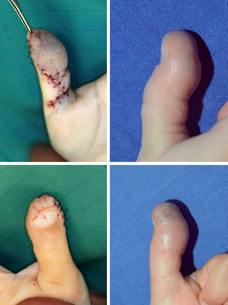 Venous malformation of the distal thumb