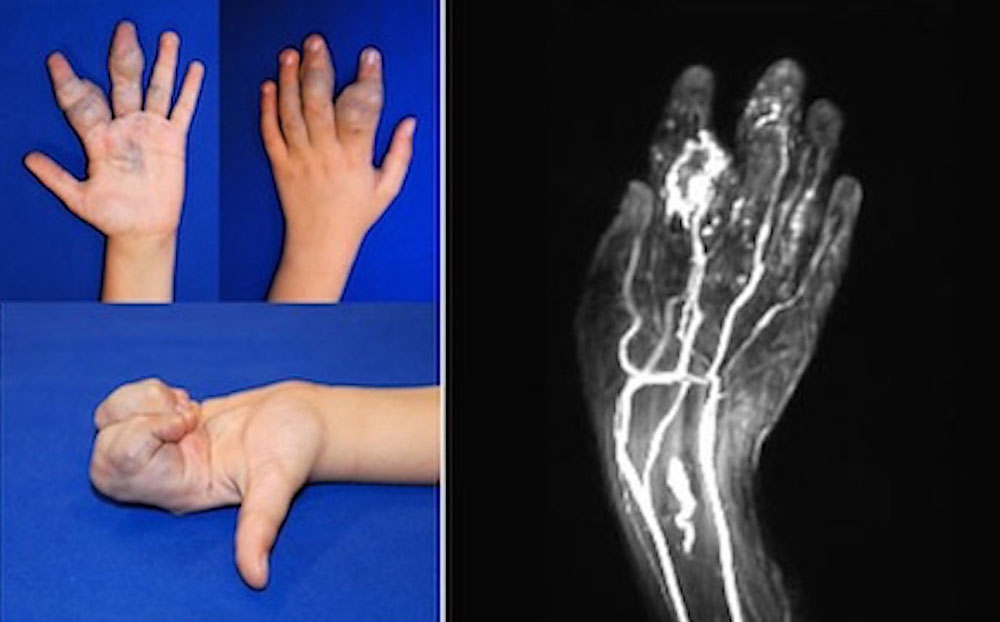 MR angiography with slow contrast enhancement