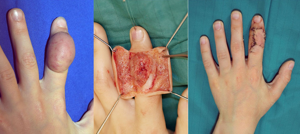 Combined lymphatic-venous malformation on the dorsal index finger