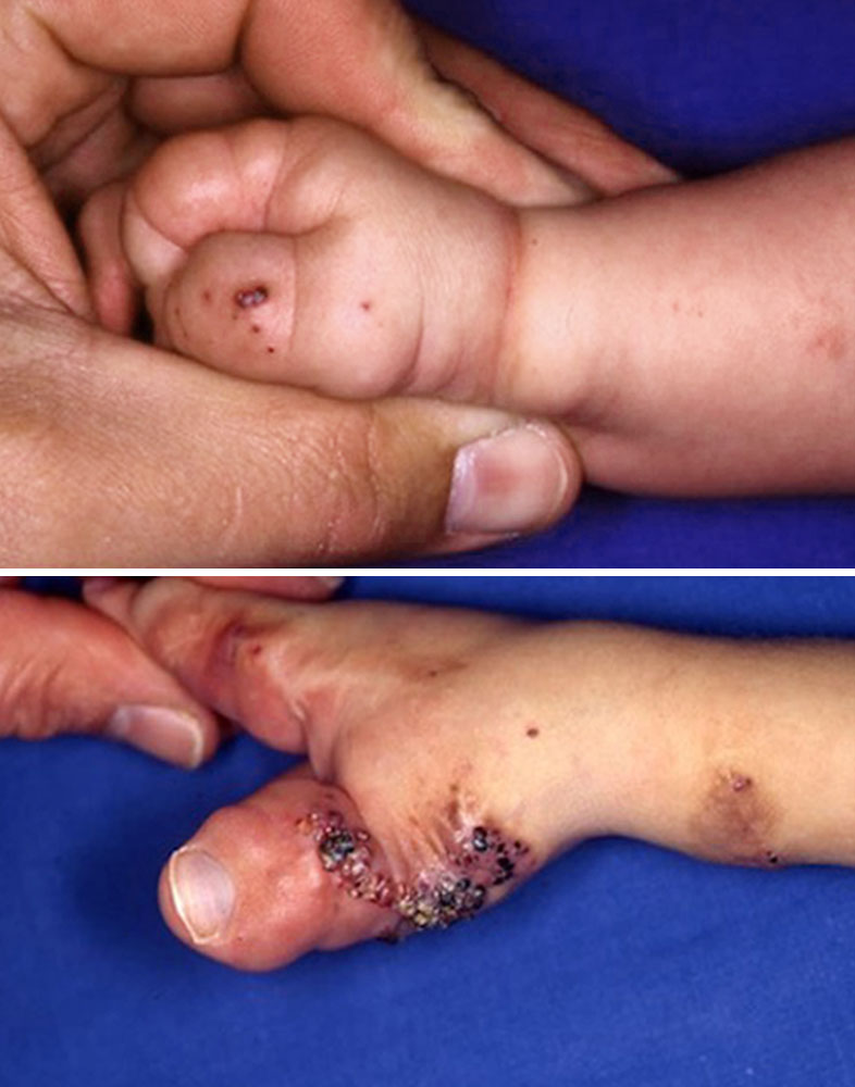 Mixed venolymphatic malformation and lymphangioma