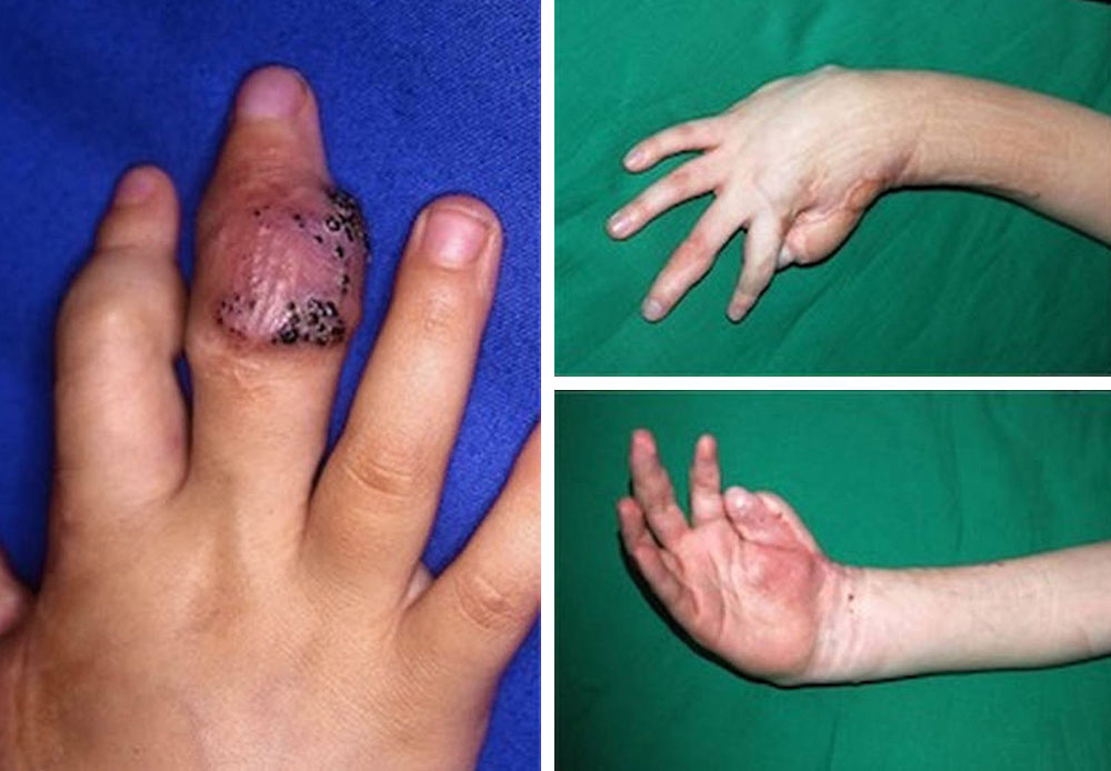 Combined venolymphatic malformation and lymphangioma circumscriptum