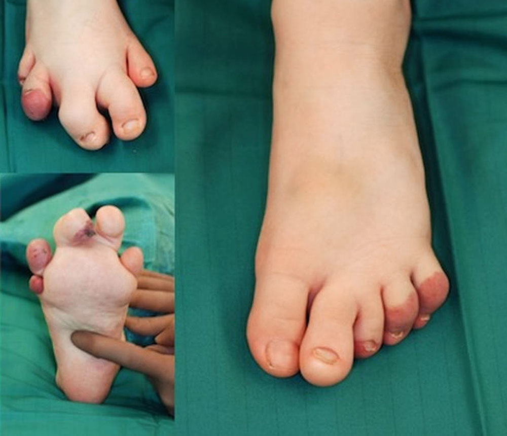 CLOVES syndrome and combined capillary–veno-lymphatic malformation