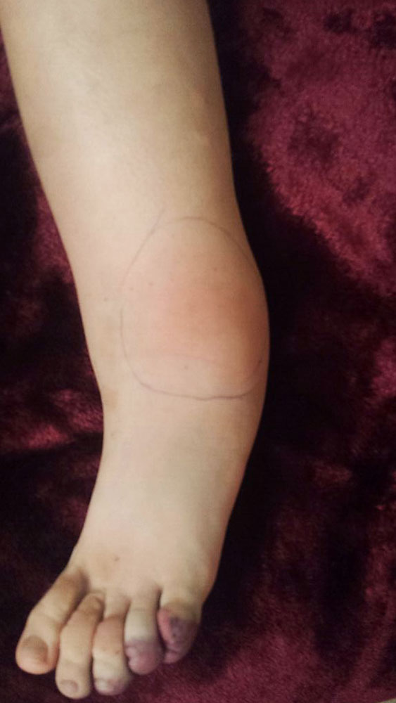 Early erysipelas in a child with lymphedema