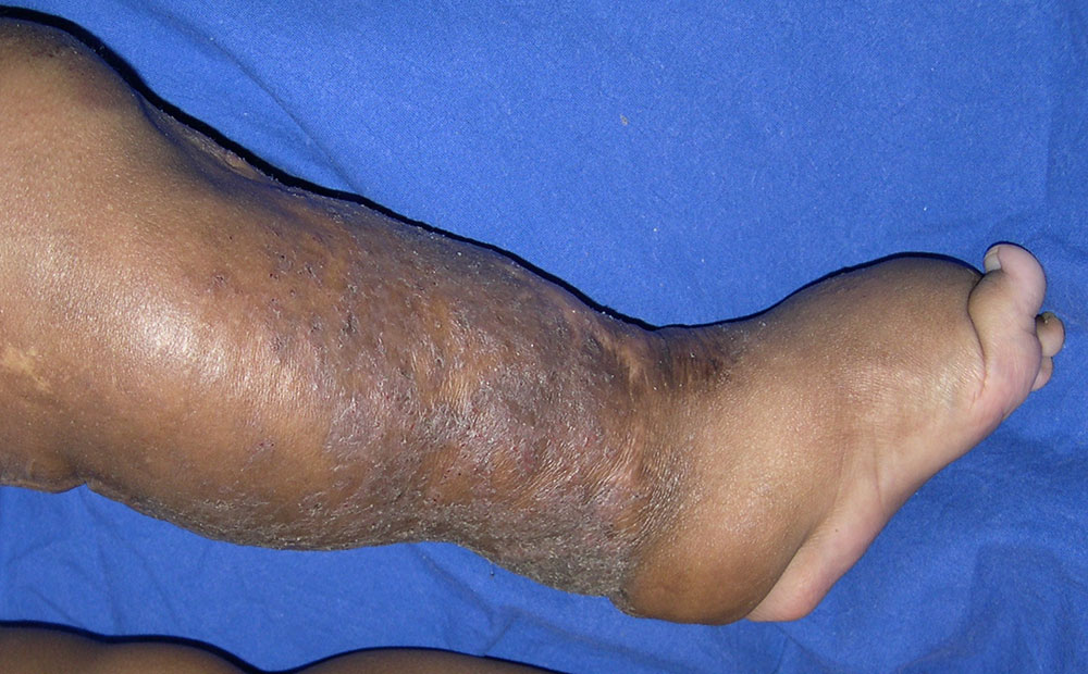 Lymphedema with cushion-like swelling
