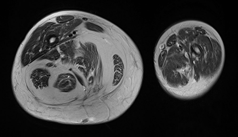 MIR: Adipose tissue hyperplasia