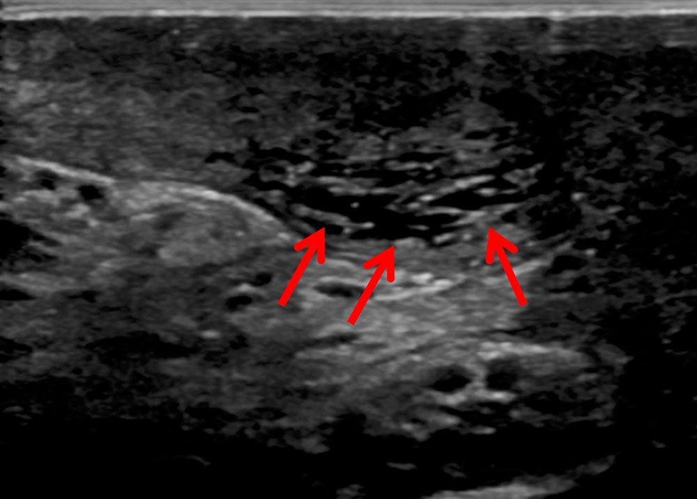 Sonography: extensive subcutaneous lymphedema