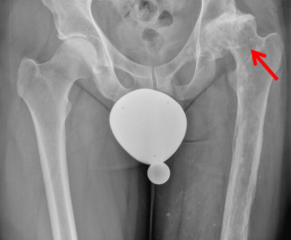 X-ray: hip joint arthrosis