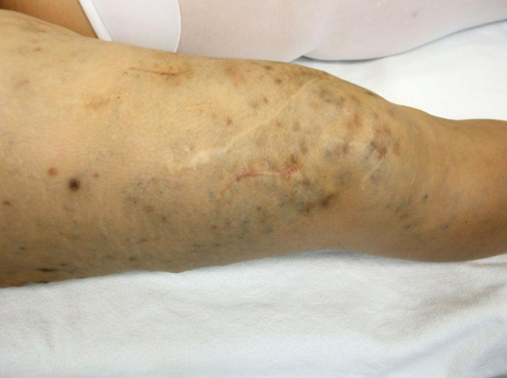 Venous malformation