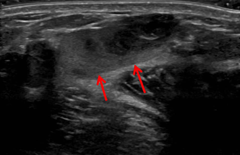 Ultrasound image: thrombophlebitis within a venous malformation