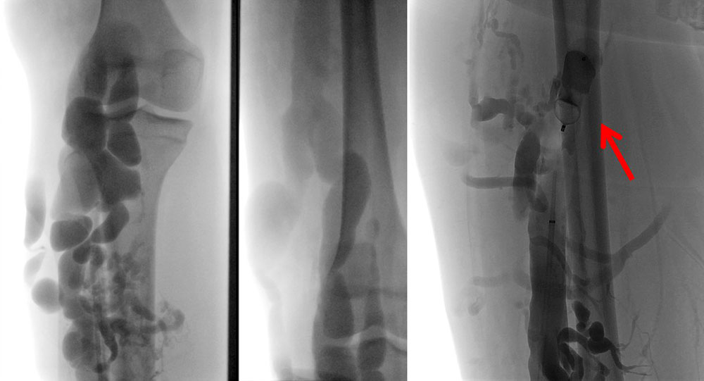 Varicography: communicating veins in venous malformation