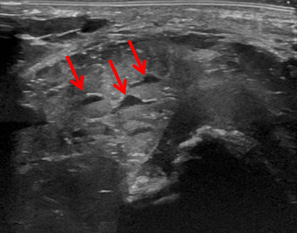 Ultrasound: venous malformation