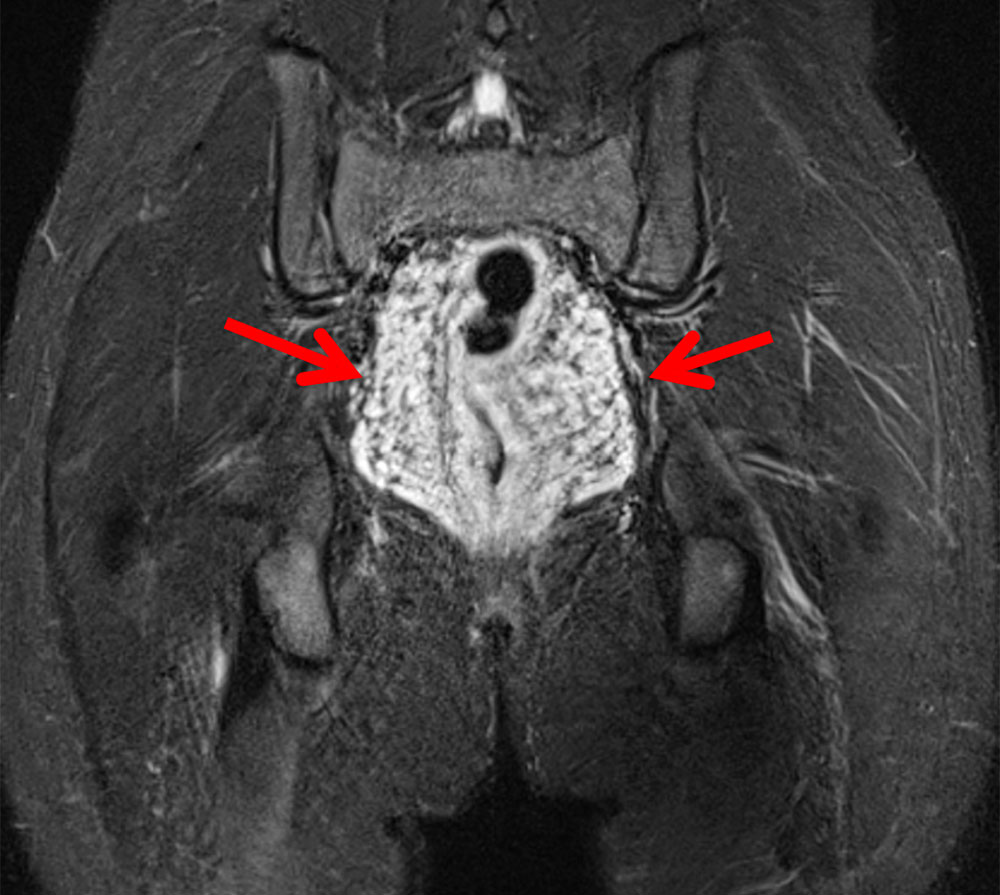 MRI: Venous malformation