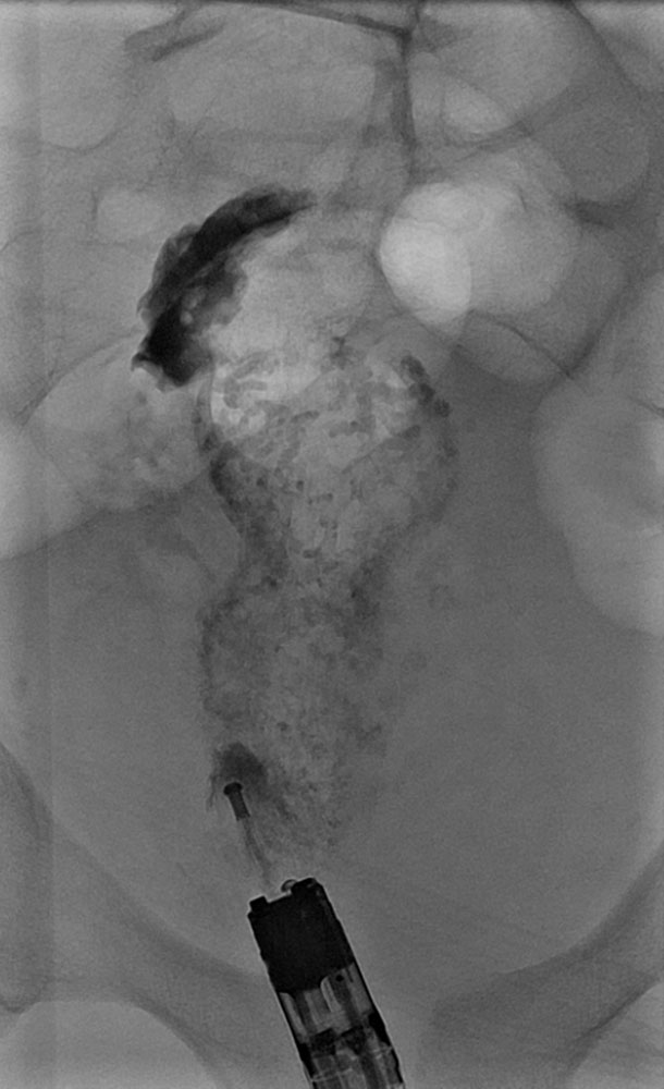 X-ray: submucosal venous malformation in rectum and sigmoid colon