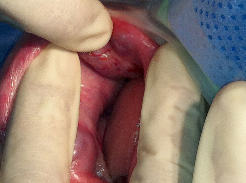 Submucosal venous malformation in the mouth