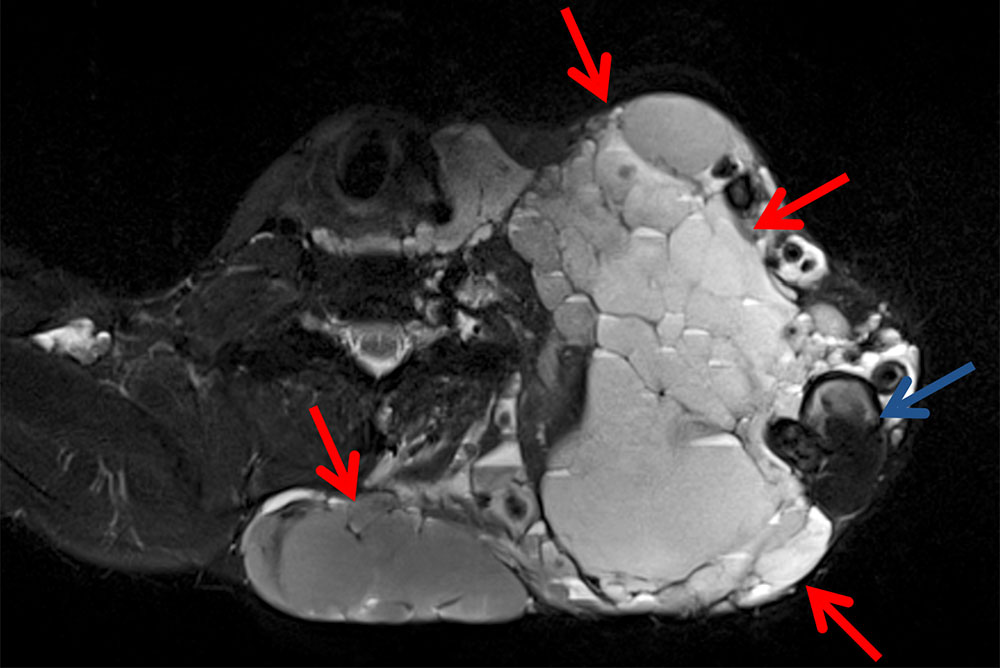 MRI: venous malformation with localized intravascular coagulation