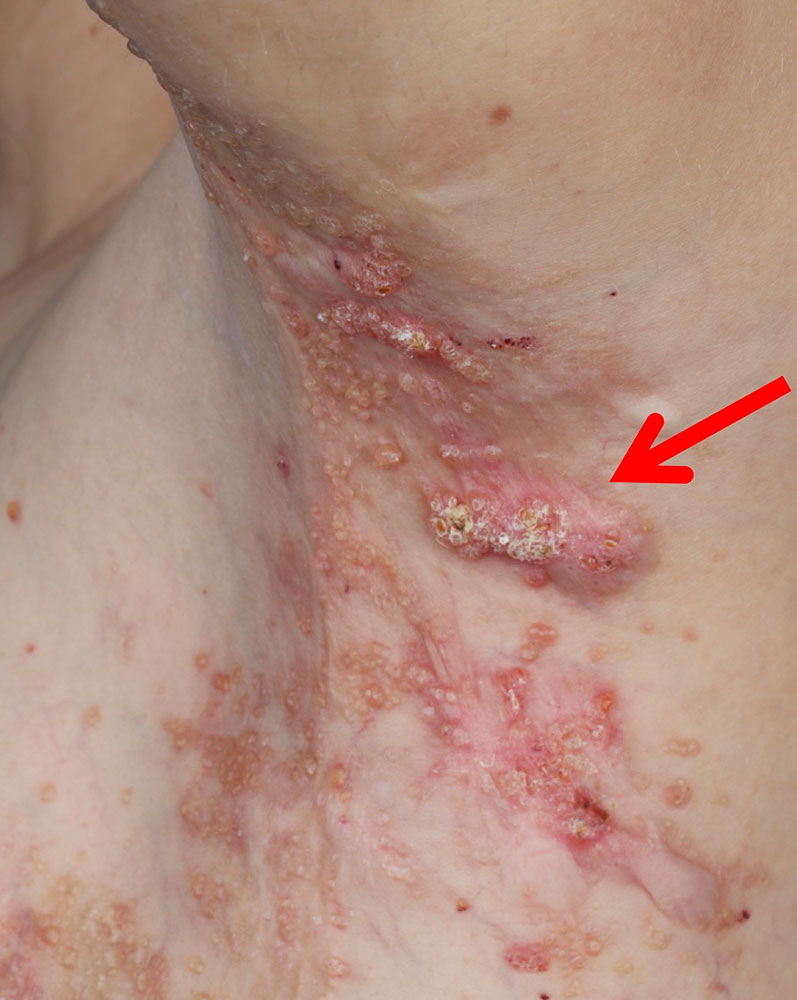 Lymphangioma circumscriptum with small, partly encrusted intracutaneous lymphatic vesicles