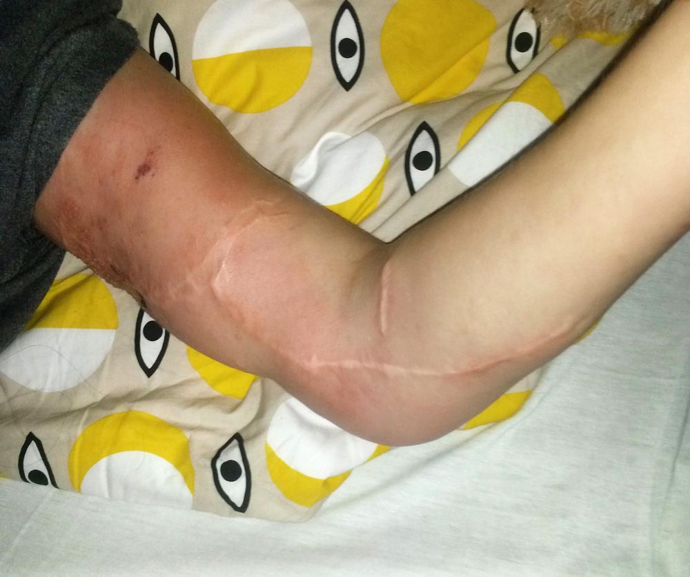 Acute erysipelas on the proximal upper arm