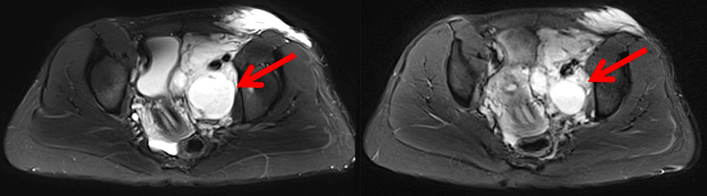 MRI: abdominal lymphatic malformation