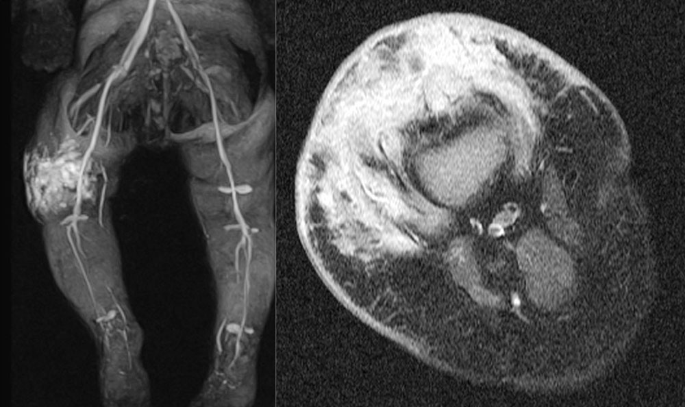 MRI: Kaposiform hemangioendothelioma