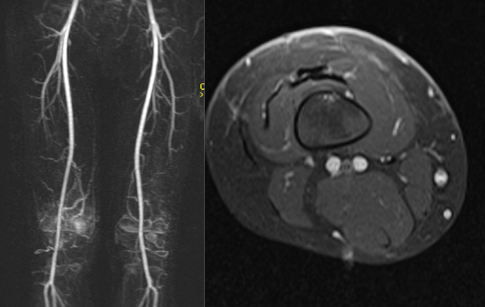 MRI: Kaposiform hemangioendothelioma