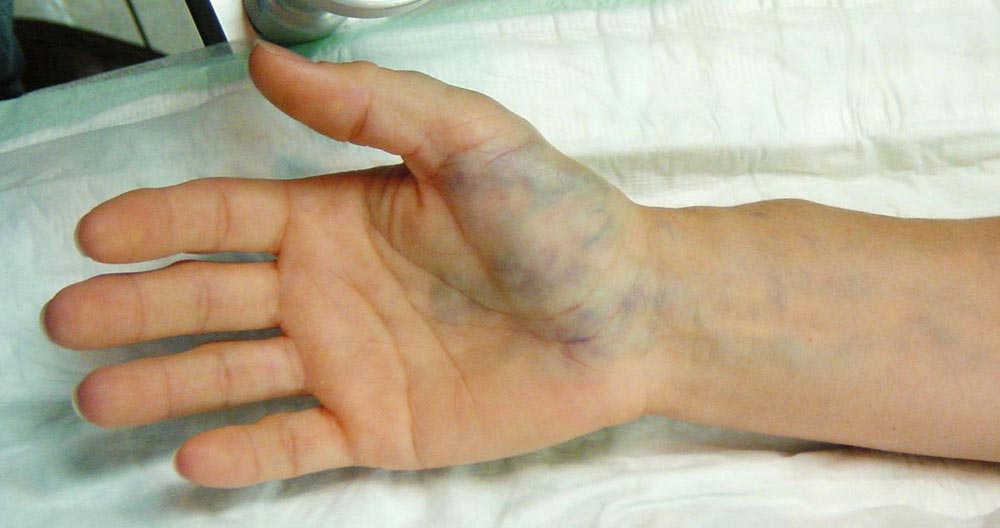 Venous malformation of the right hand