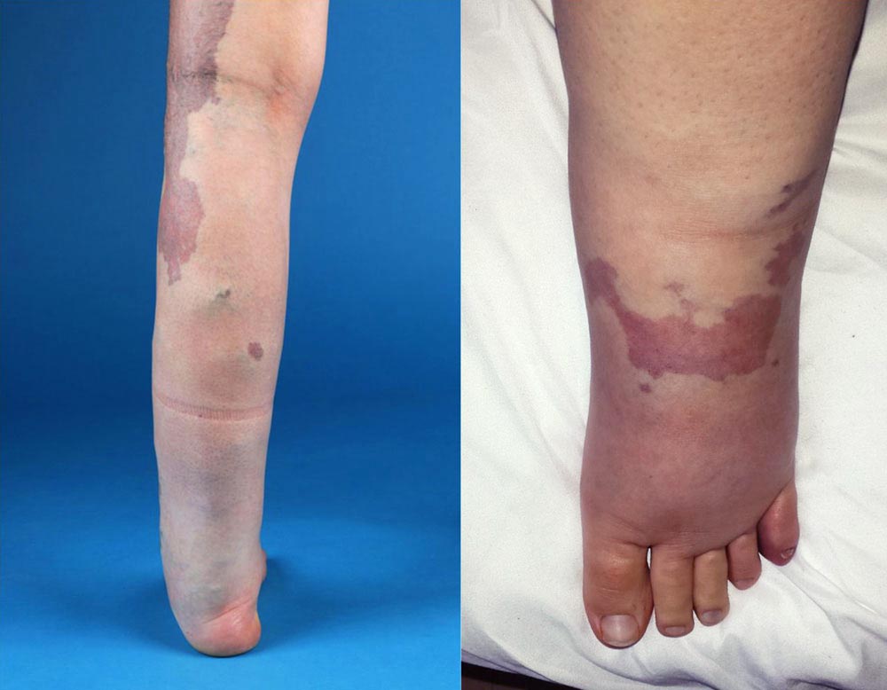 Combined lymphedema and phlebedema in a Klippel-Trénaunay patient