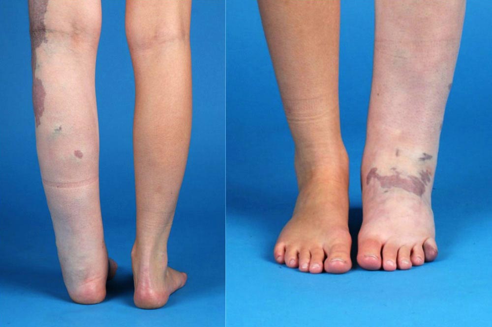 Significant improvement, including of the lymphedema