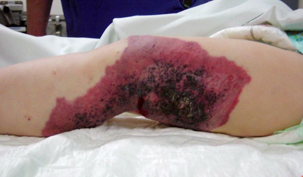 Capillary malformation in Klippel-Trénaunay syndrome