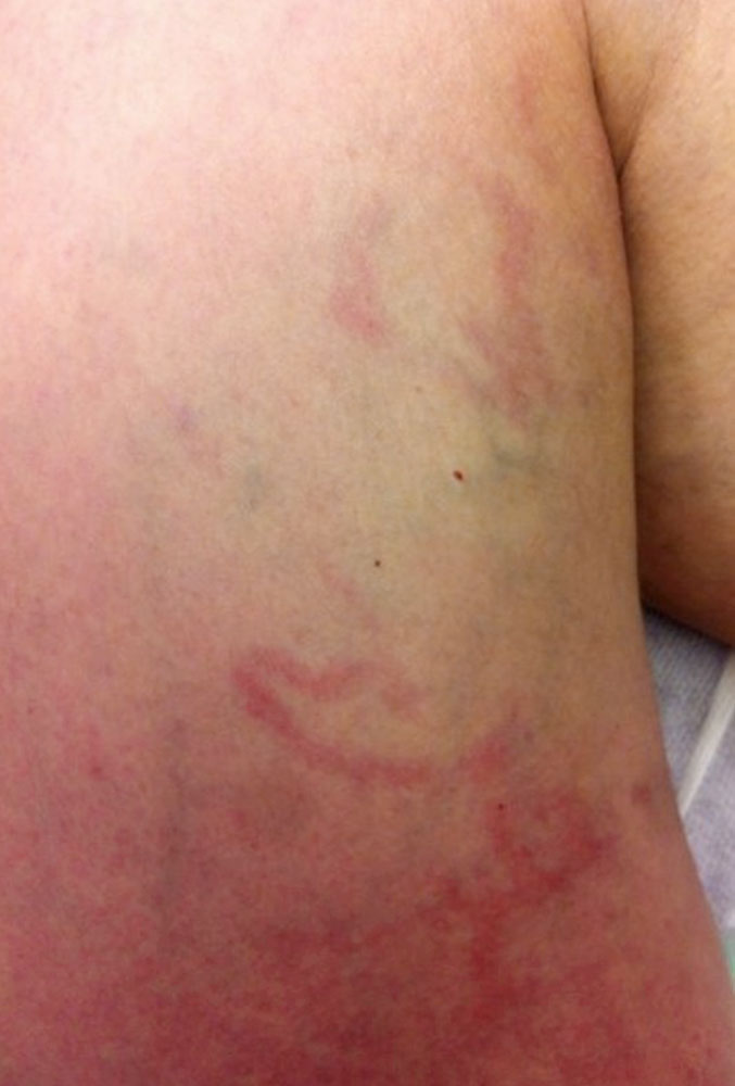 Acute erysipelas in a patient with chronic lymphedema