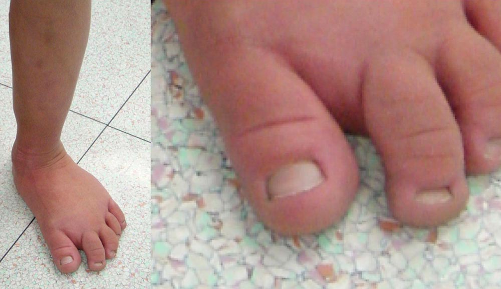 Ballooned hyperplasia of the foot