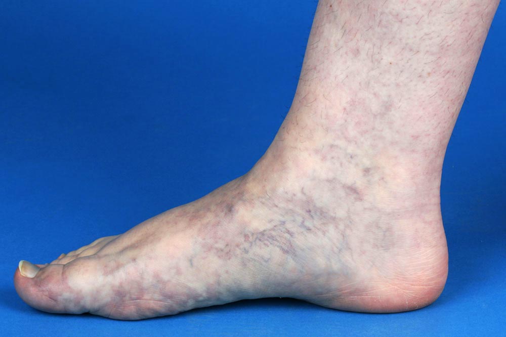 combined capillary-venous malformation, high venous pressure