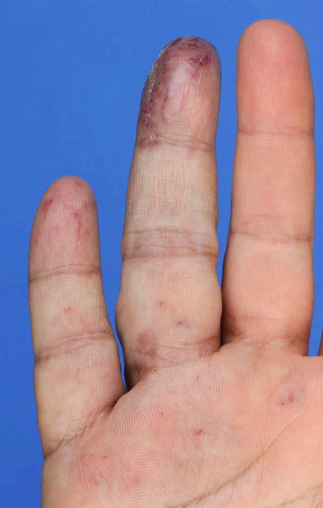 Chronic, non-healing wound on the tip of the finger