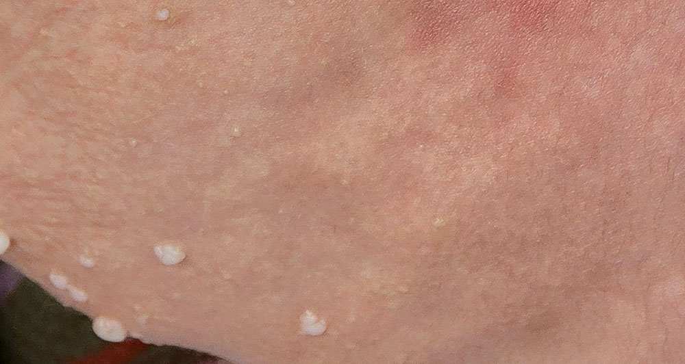 Lymphatic vesicles on the skin